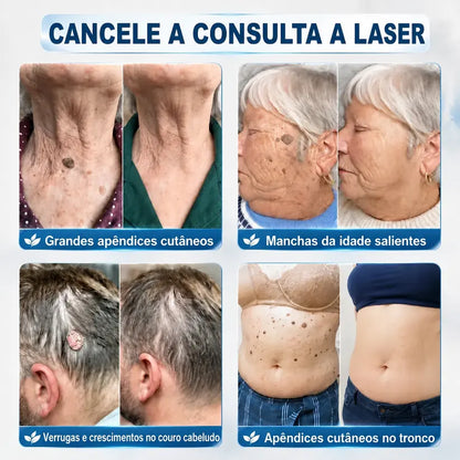 🍀👑 𝐏𝒊𝐜𝐝𝒐® Removedor de Acrocórdons e Manchas em 7 Dias (Sem dor, sem cicatrizes — aplicador roll-on) 💪