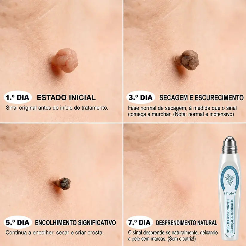 🍀👑 𝐏𝒊𝐜𝐝𝒐® Removedor de Acrocórdons e Manchas em 7 Dias (Sem dor, sem cicatrizes — aplicador roll-on) 💪