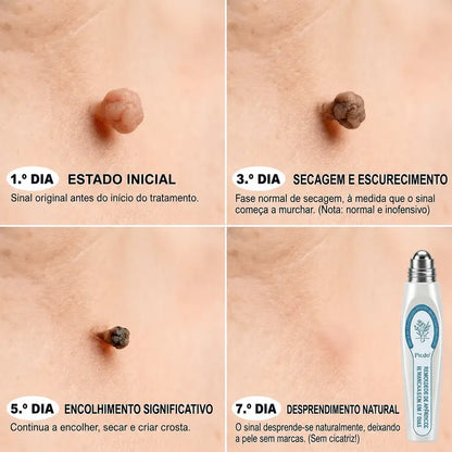 🍀👑 𝐏𝒊𝐜𝐝𝒐® Removedor de Acrocórdons e Manchas em 7 Dias (Sem dor, sem cicatrizes — aplicador roll-on) 💪