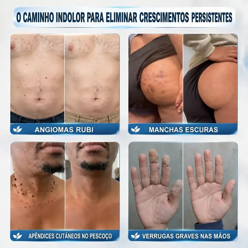 🍀👑 𝐏𝒊𝐜𝐝𝒐® Removedor de Acrocórdons e Manchas em 7 Dias (Sem dor, sem cicatrizes — aplicador roll-on) 💪