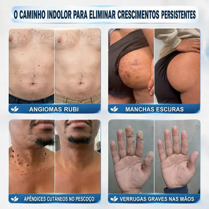 🍀👑 𝐏𝒊𝐜𝐝𝒐® Removedor de Acrocórdons e Manchas em 7 Dias (Sem dor, sem cicatrizes — aplicador roll-on) 💪